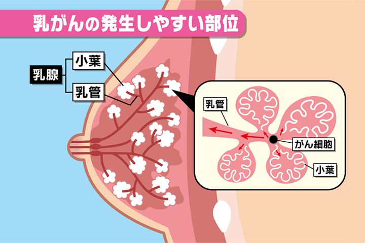 乳がんの発生しやすい部位